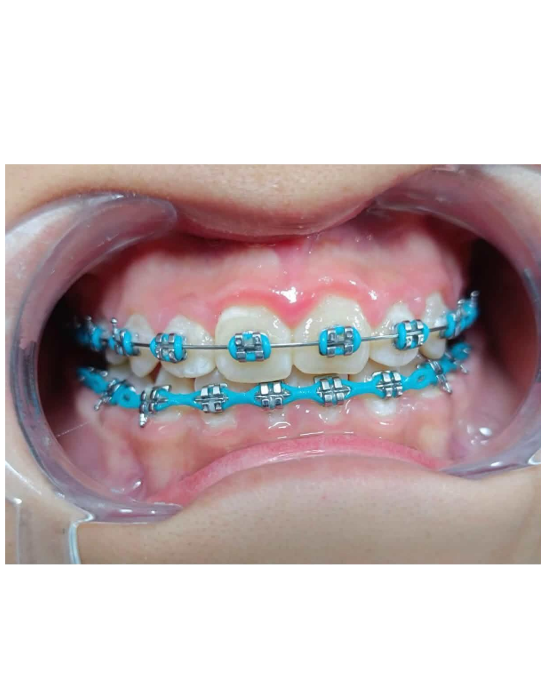 Frenillos Brackets